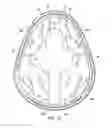 Fig. 18 - Surgical method for implantable head mounted neurostimulation system for head pain