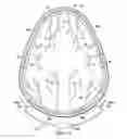 Fig. 19 - Surgical method for implantable head mounted neurostimulation system for head pain