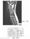 Fig. 09 - High density epidural stimulation for facilitation of locomotion, posture, voluntary movement, and recovery of autonomic, sexual, vasomotor, and cognitive function after neurological injury