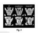 Fig. 04 - Methods for treating osteogenesis imperfecta