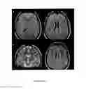 Fig. 10 - Method for Diagnosing or Predicting a Non Syndromic Autosomal Recessive Optic Atrophy, or a Risk of a Non Syndromic Autosomal Recessive Optic Atrophy