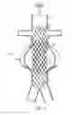 Fig. 03 - Variable porosity intravascular implant and manufacturing method