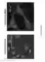 Fig. 11 - Methods for the diagnosis of amyotrophic lateral sclerosis