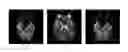 Fig. 01 - Method for detecting and quantifying cerebral infarct