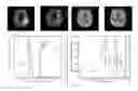 Fig. 02 - Method for detecting and quantifying cerebral infarct