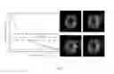 Fig. 08 - Method for detecting and quantifying cerebral infarct