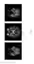 Fig. 11 - Method for detecting and quantifying cerebral infarct
