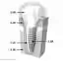 Fig. 01 - Method of determining an indicator for the stability of a bone implant