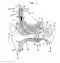 Fig. 02 - Hearing prosthesis with a piezoelectric actuator
