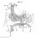 Fig. 16 - Hearing prosthesis with a piezoelectric actuator