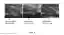 Fig. 02 - Renal denervation using nerve fluorescing dye