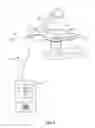 Fig. 04 - Renal denervation using nerve fluorescing dye