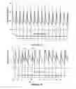 Fig. 04 - Method and system for detecting heartbeat irregularities