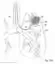 Fig. 18 - Method and apparatus for endobronchial diagnosis
