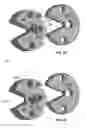 Fig. 63 - Multiple-firing suture fixation device and methods for using and manufacturing same