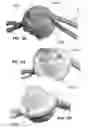 Fig. 79 - Multiple-firing suture fixation device and methods for using and manufacturing same
