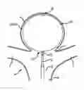 Fig. 01 - Electrolytic and mechanical detachment for implant delivery systems