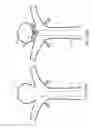 Fig. 22 - Wing bifurcation reconstruction device