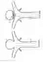 Fig. 28 - Wing bifurcation reconstruction device