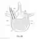 Fig. 07 - Systems for treating a vertebral body