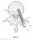 Fig. 03 - Pedicle screw with electro-conductive coating or portion