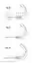 Fig. 06 - IMPLANT AND SYSTEM FOR BONE REPAIR