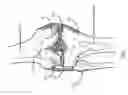 Fig. 02 - Method for creating a customized arthroplasty resection guide utilizing two-dimensional imaging