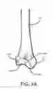 Fig. 03 - Method for creating a customized arthroplasty resection guide utilizing two-dimensional imaging
