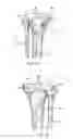 Fig. 05 - Method for creating a customized arthroplasty resection guide utilizing two-dimensional imaging