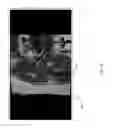 Fig. 15 - Method for creating a customized arthroplasty resection guide utilizing two-dimensional imaging