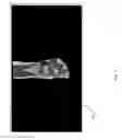 Fig. 16 - Method for creating a customized arthroplasty resection guide utilizing two-dimensional imaging