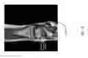 Fig. 17 - Method for creating a customized arthroplasty resection guide utilizing two-dimensional imaging