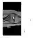 Fig. 18 - Method for creating a customized arthroplasty resection guide utilizing two-dimensional imaging