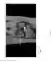 Fig. 20 - Method for creating a customized arthroplasty resection guide utilizing two-dimensional imaging