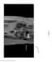 Fig. 22 - Method for creating a customized arthroplasty resection guide utilizing two-dimensional imaging