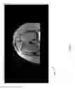 Fig. 25 - Method for creating a customized arthroplasty resection guide utilizing two-dimensional imaging