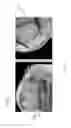 Fig. 32 - Method for creating a customized arthroplasty resection guide utilizing two-dimensional imaging