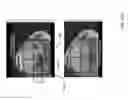 Fig. 45 - Method for creating a customized arthroplasty resection guide utilizing two-dimensional imaging