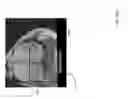 Fig. 46 - Method for creating a customized arthroplasty resection guide utilizing two-dimensional imaging