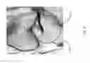 Fig. 49 - Method for creating a customized arthroplasty resection guide utilizing two-dimensional imaging
