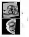 Fig. 50 - Method for creating a customized arthroplasty resection guide utilizing two-dimensional imaging