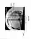 Fig. 57 - Method for creating a customized arthroplasty resection guide utilizing two-dimensional imaging