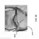 Fig. 59 - Method for creating a customized arthroplasty resection guide utilizing two-dimensional imaging