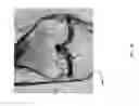 Fig. 62 - Method for creating a customized arthroplasty resection guide utilizing two-dimensional imaging