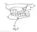 Fig. 09 - Bone foundation guide system and method