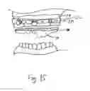 Fig. 16 - Bone foundation guide system and method