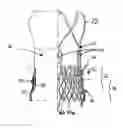Fig. 01 - Transcatheter stent-valves