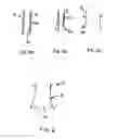 Fig. 05 - Transcatheter stent-valves