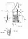 Fig. 13 - Transcatheter stent-valves