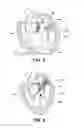 Fig. 06 - HEART VALVE PROSTHESIS WITH COLLAPSIBLE VALVE AND METHOD OF DELIVERY THEREOF
